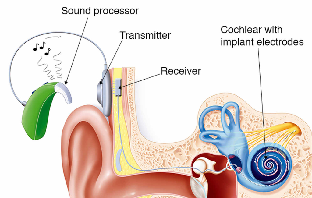 cochlear-implant-graphic